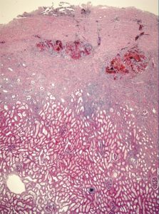 Histologie der Schnittkante einer Nierenteilresektion nach 3 Wochen